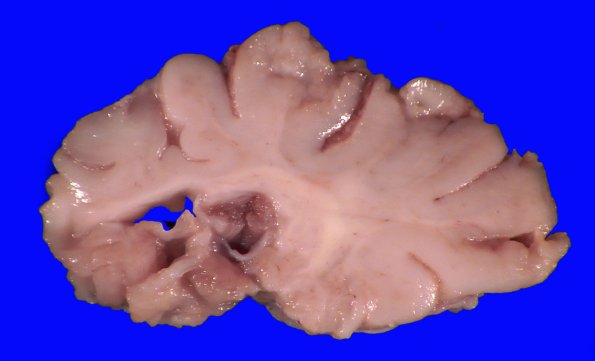 13B3 (Case 13).A.007