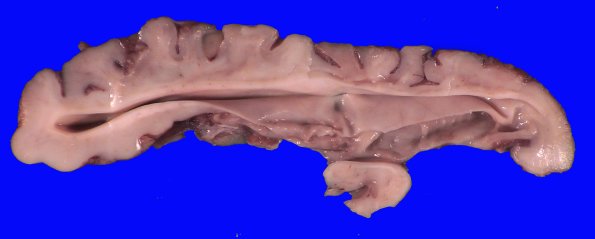 13B7 (Case 13).A.014
