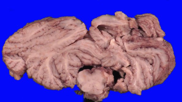 13B9B (Case 13).A.030