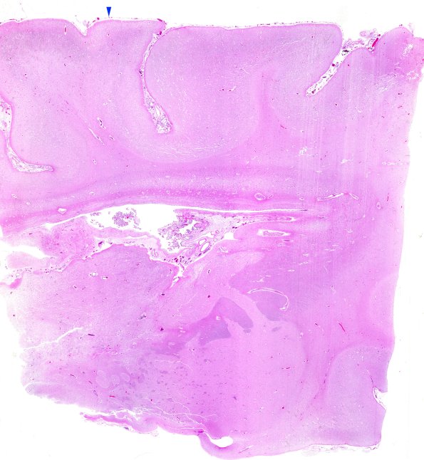 13D0 (Case 13) A