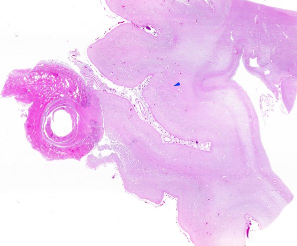 13E0 (Case 13) C