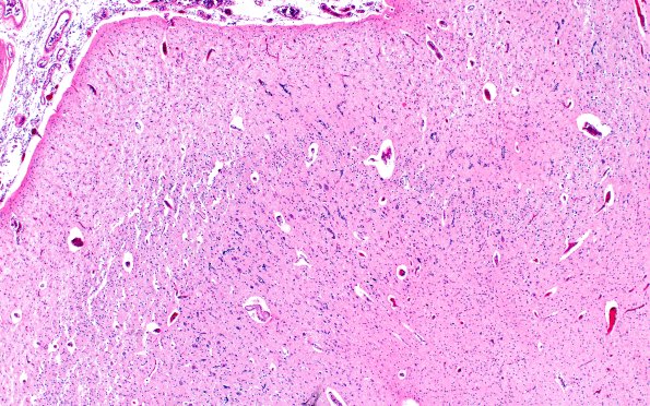 13E1 (Case 13) A3 H&E 4X 2