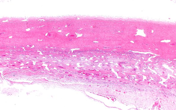 13L2 Hygroma A13 (Case 13) H&E 2X