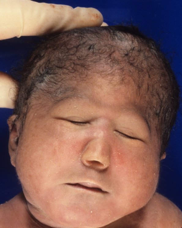 1A Holoprosencephaly (Case 1) 1