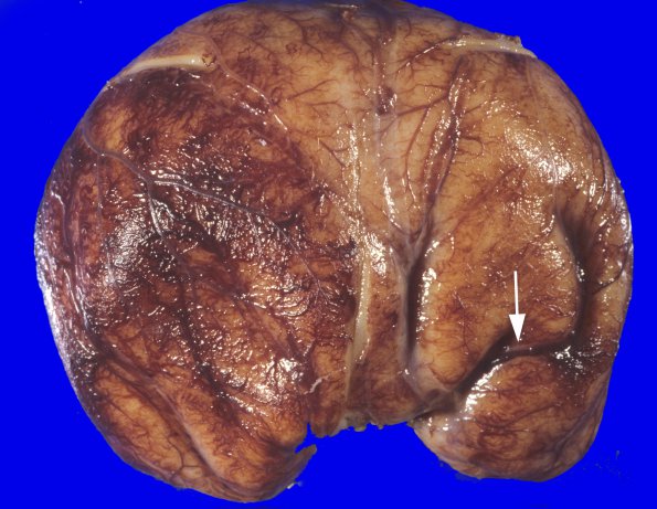 1B2 Holoprosencephaly (Case 1) 3A