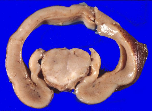 1B4 Holoprosencephaly (Case 1) 4A