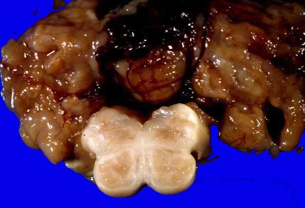 1B6 Holoprosencephaly (Case 1) 8A