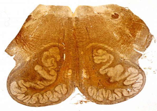 1C Holoprosencephaly (Case 1) 7