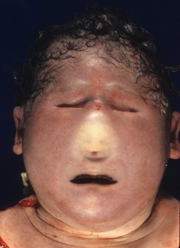 2A1 Holoprosencephaly (Case 2) 1