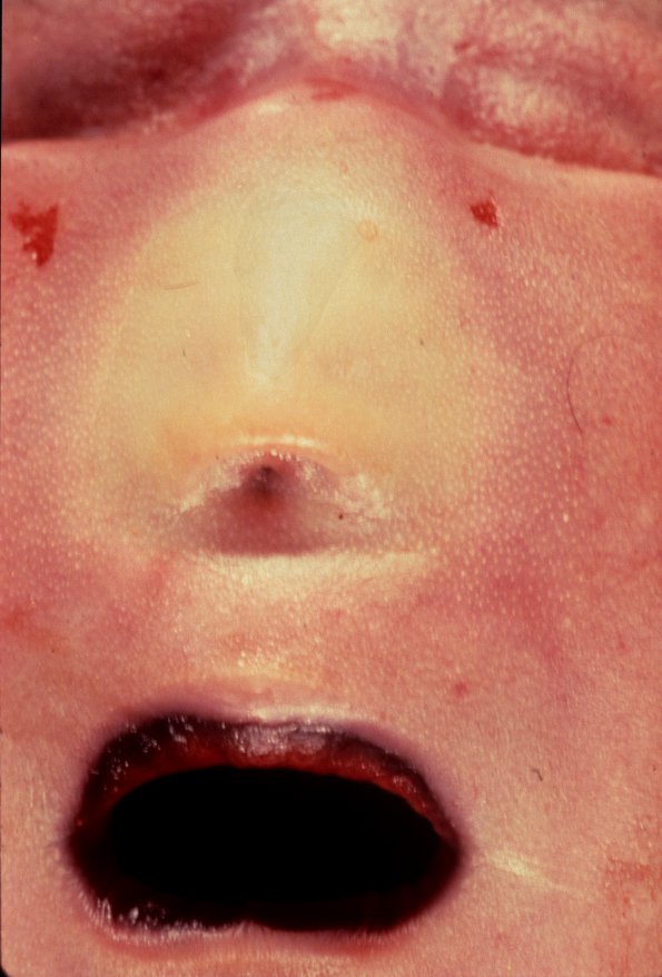 2A2 Holoprosencephaly (Case 2) 1b