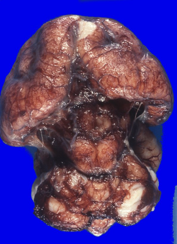 2B1 Holoprosencephaly (Case 2) 2A