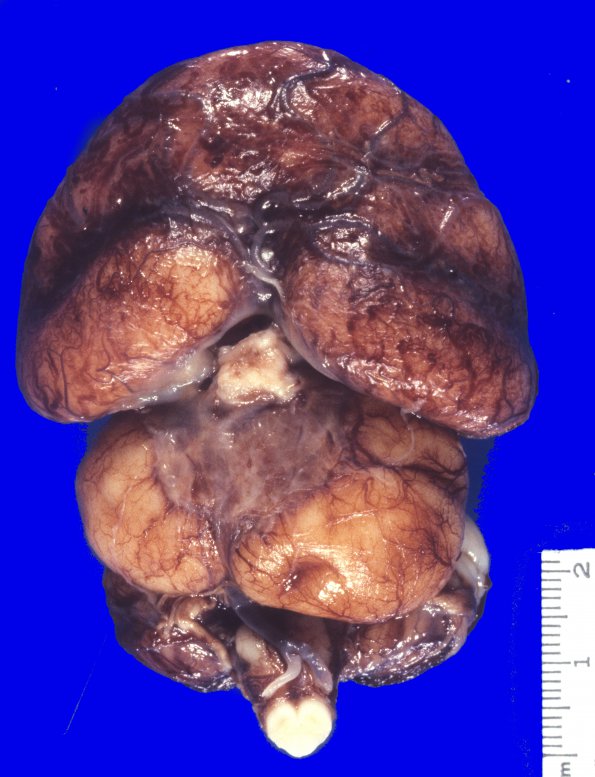 2B2 Holoprosencephaly (Case 2) 4A