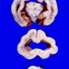 2B3 Holoprosencephaly (Case 2) 6A