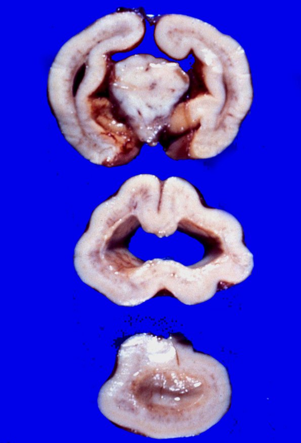 2B3 Holoprosencephaly (Case 2) 6A