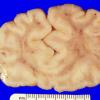 3A1 Holoprosencephaly (Case 3) 1A