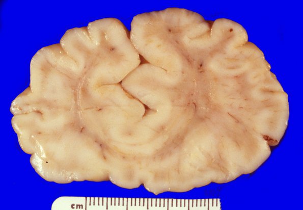 3A1 Holoprosencephaly (Case 3) 1A