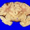 3A2 Holoprosencephaly (Case 3) 7, Trisomy 13A