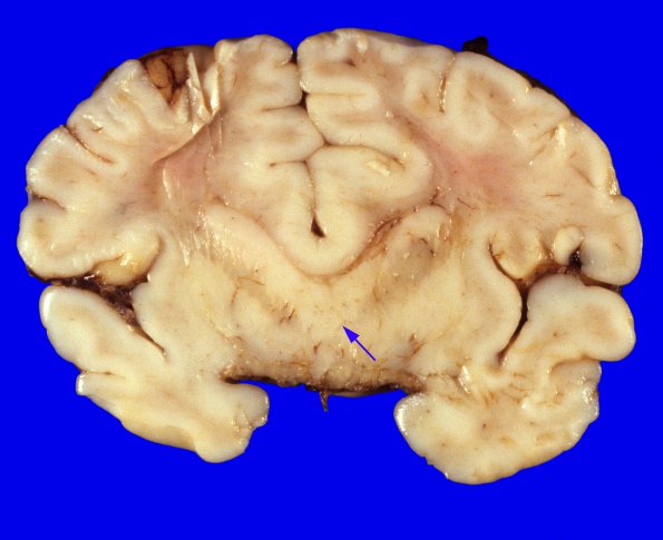 3A2 Holoprosencephaly (Case 3) 7, Trisomy 13A