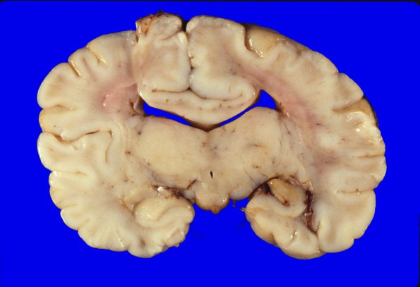 3A3 Holoprosencephaly (Case 3) 3AA