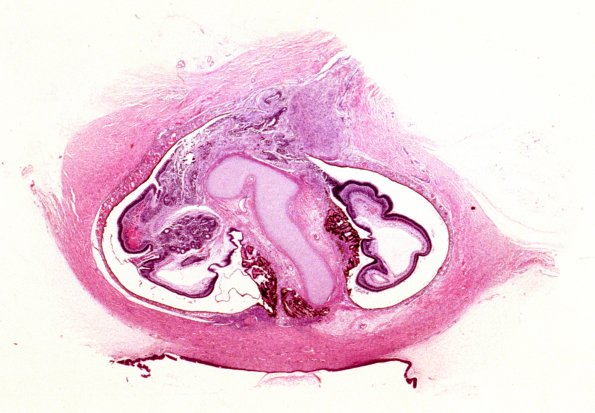 3B1 Holoprosencephaly (Case 3) 2, Trisomy 13H&E 3A