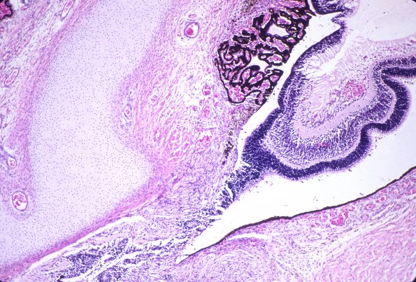 3B2 Holoprosencephaly (Case 3) 2, Trisomy 13 H&E 1