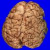 4A1 Holoprosencephaly variant & (Case 4) 1A