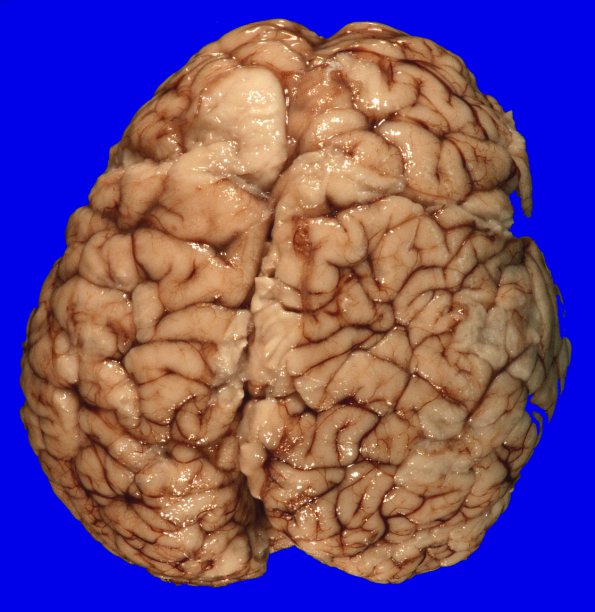 4A1 Holoprosencephaly variant & (Case 4) 1A