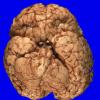 4A2 Holoprosencephaly variant & (Case 4) 3A