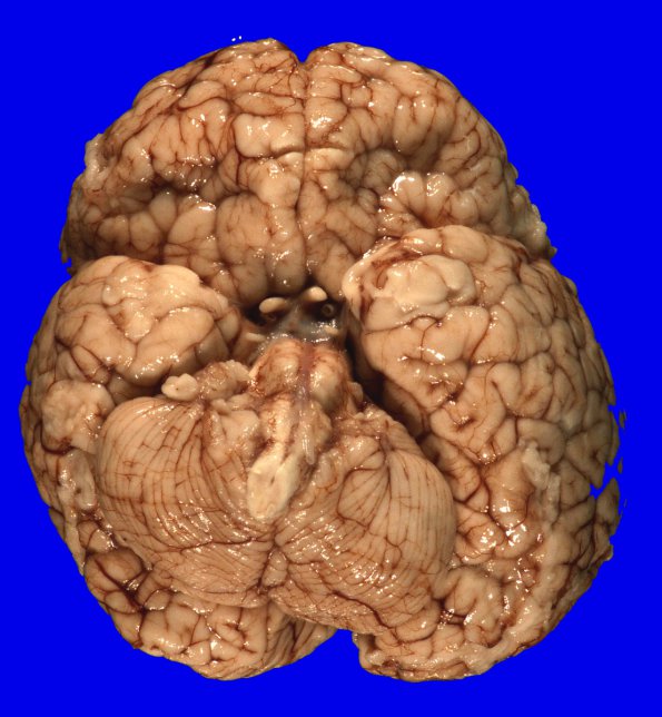 4A2 Holoprosencephaly variant & (Case 4) 3A