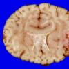 4A3 Holoprosencephaly variant & (Case 4) 6 - CopyA