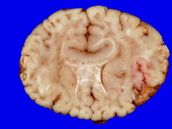 4A3 Holoprosencephaly variant & (Case 4) 6 - CopyA