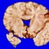 4A4 Holoprosencephaly variant & (Case 4) 8 - CopyA