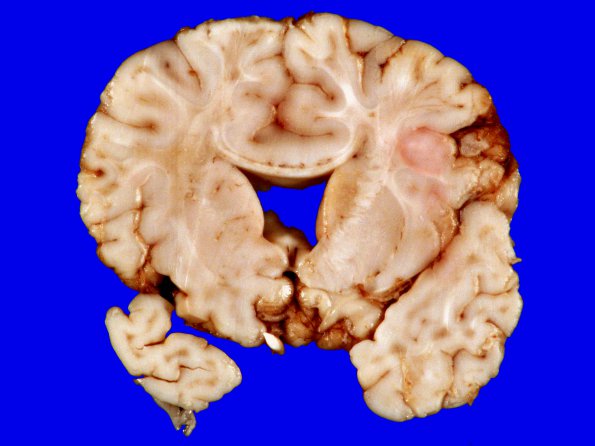 4A4 Holoprosencephaly variant & (Case 4) 8 - CopyA