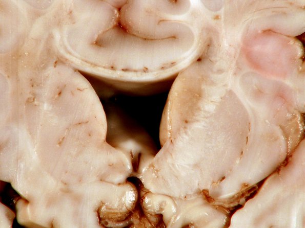 4A5 Holoprosencephaly variant & (Case 4) 9