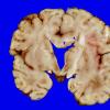 4A6 Holoprosencephaly variant & (Case 4) 13A