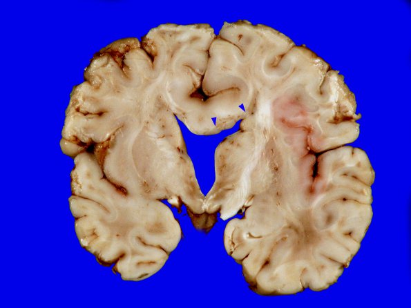 4A6 Holoprosencephaly variant & (Case 4) 13A