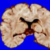 4A7 Holoprosencephaly variant & (Case 4) 15A