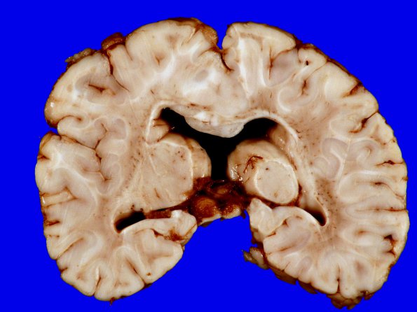 4A7 Holoprosencephaly variant & (Case 4) 15A