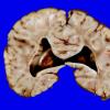 4A8 Holoprosencephaly variant & (Case 4) 17A