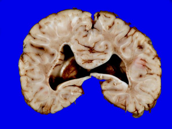 4A8 Holoprosencephaly variant & (Case 4) 17A