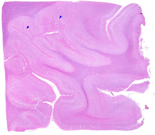 4B Holoprosencephaly variant & (Case 4) cortex H&E A