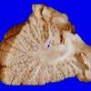 4D1 Holoprosencephaly variant & (Case 4) 18aAA