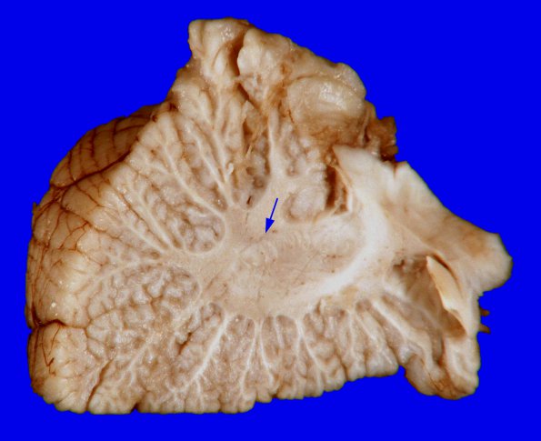 4D1 Holoprosencephaly variant & (Case 4) 18aAA