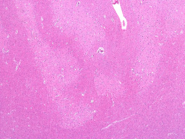 4D2 Holoprosencephaly variant & (Case 4) H&E dentate