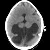 5A2 Holoprosencephaly, partial (Case 5)