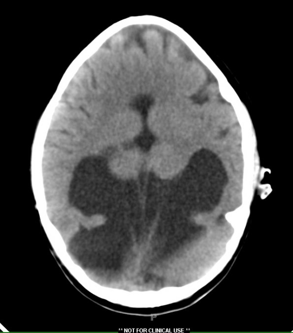 5A2 Holoprosencephaly, partial (Case 5)