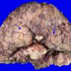 5D1 Holoprosencephaly, partial (Case 5)_8A