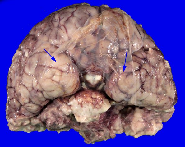 5D1 Holoprosencephaly, partial (Case 5)_8A