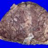 5D2 Holoprosencephaly, partial (Case 5)_9A