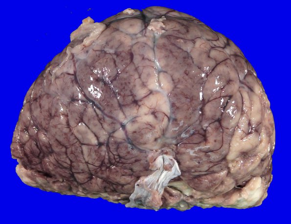 5D2 Holoprosencephaly, partial (Case 5)_9A